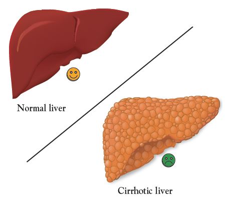 Illustration showing a healthy liver, with a smooth surface, next to a cirrhotic liver, with a mottled surface, for comparison.
