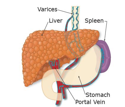 Illustration showing a cirrhotic liver and varrices, and the nearby liver, spleen, and portal vein.