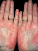 palmar erythema