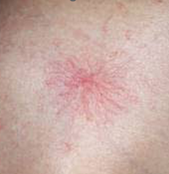 spider angioma