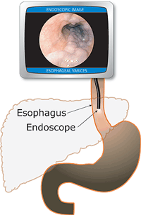 Graphic of jaundice